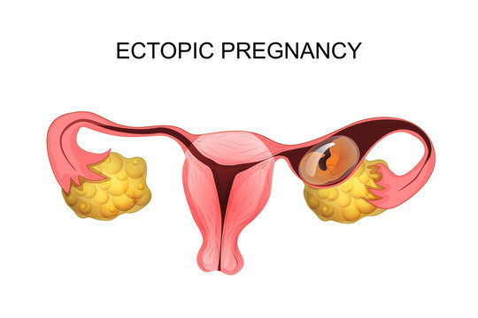 Read more about the article الحمل خارج الرحم اسبابه واعراضه وطرق العلاج