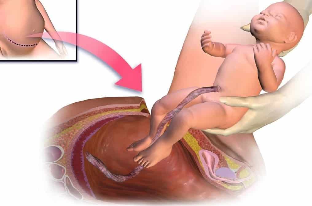 Read more about the article التهاب جرح القيصرية اسبابه وطرق العلاج وطرق الوقاية منه